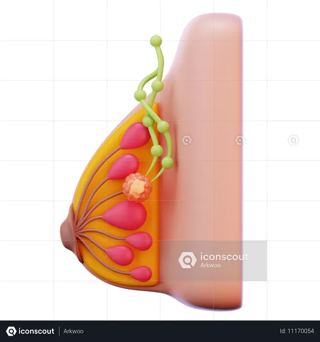 Câncer de mama estágio 2  3D Icon