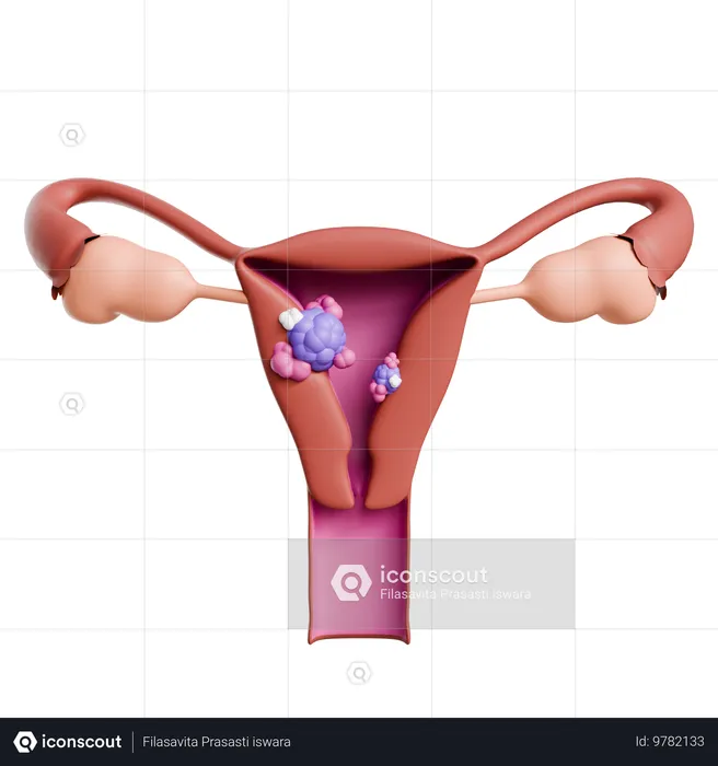 Cáncer de útero  3D Icon