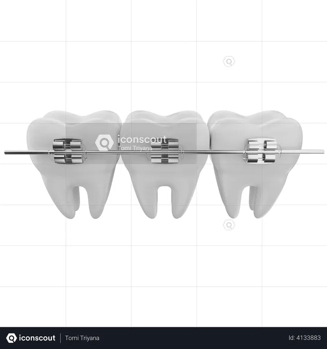 Dental braces  3D Illustration