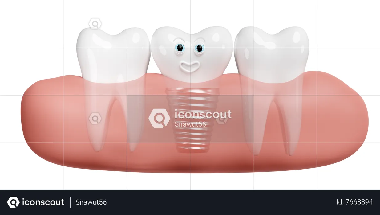 Gum with dental implant  3D Illustration