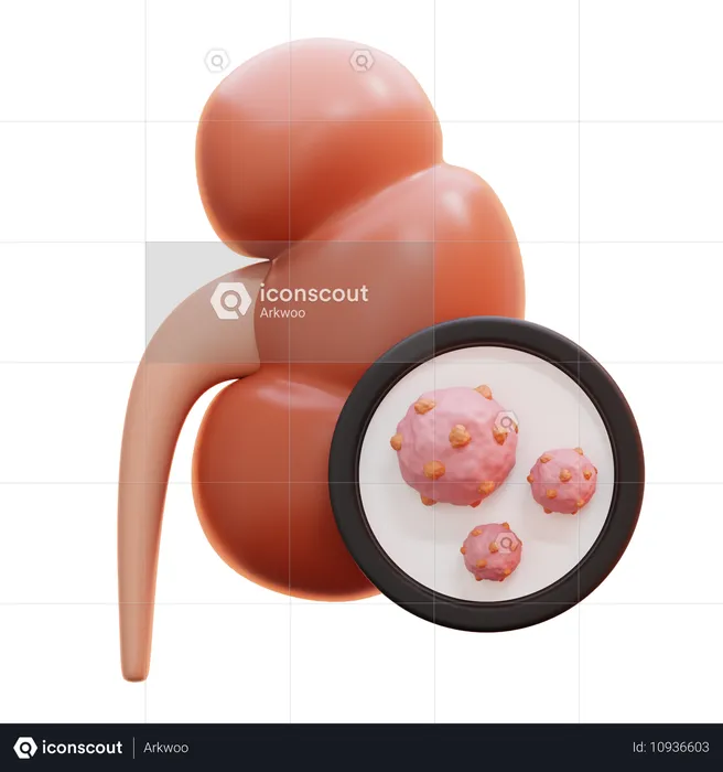 Kidney cancer  3D Icon