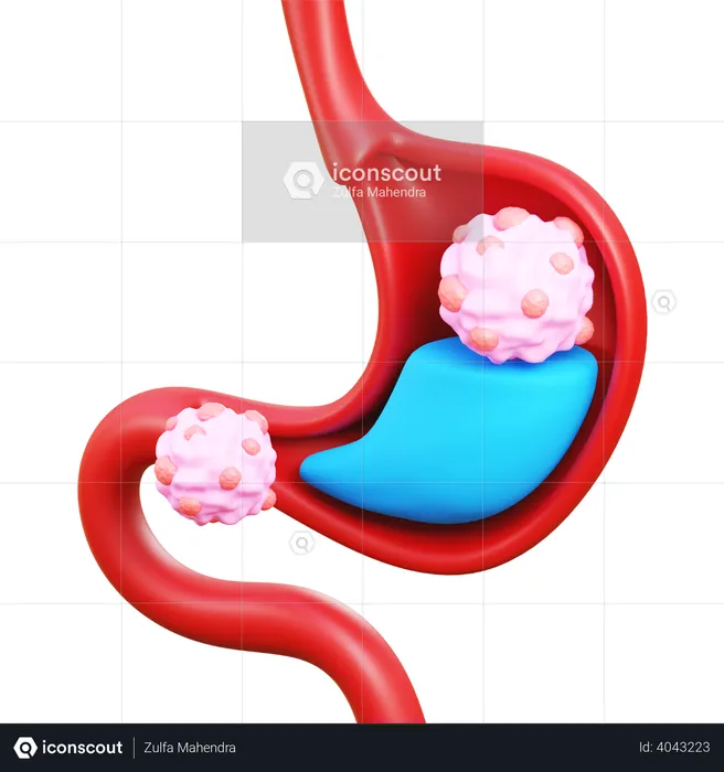 Stomach cancer  3D Icon