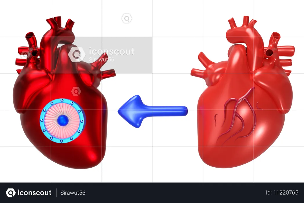 Transplantation cardiaque  3D Icon