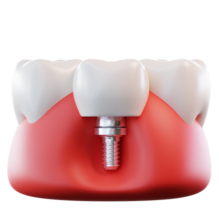 歯科インプラント  3D Icon