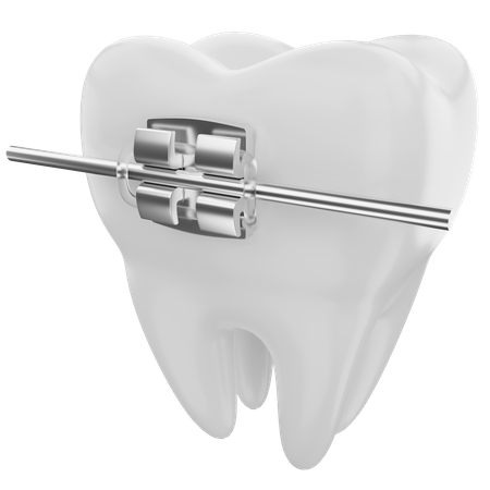 Appareils dentaires  3D Illustration
