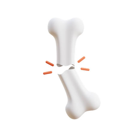 Bone Fracture  3D Illustration