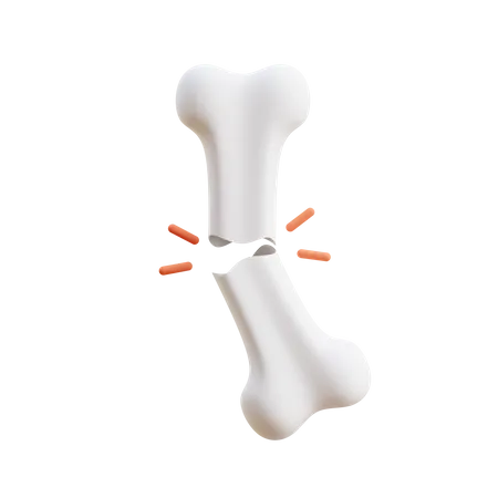 Bone Fracture  3D Illustration