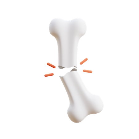 Bone Fracture 3D Illustration