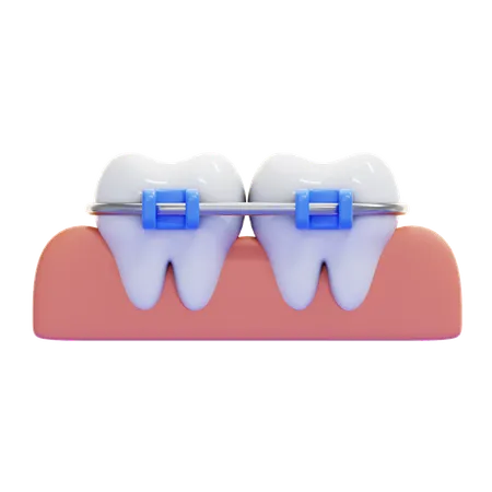 BRACES  3D Icon