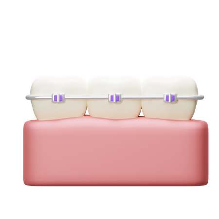 Braces Tooth  3D Icon