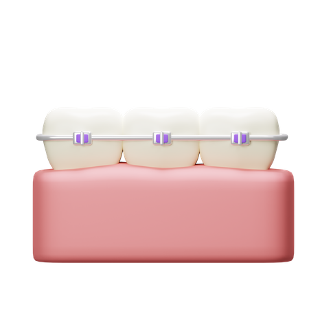 Braces Tooth  3D Icon