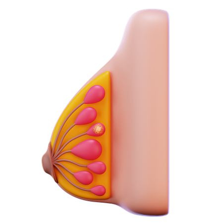 Breast Cancer Stage  3D Icon