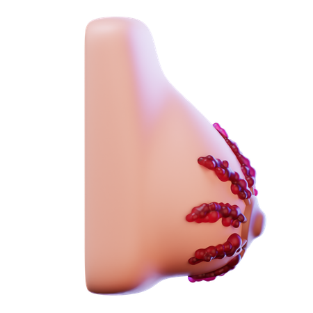 Breast Cancer Stage  3D Icon