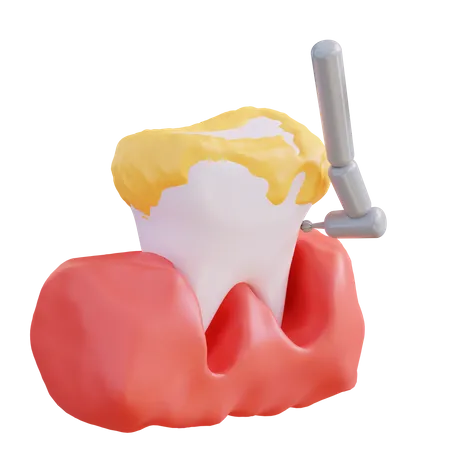 Ilustracao 3 D De Limpeza De Tartaro Com Uma Broca Dentaria 3D Icon