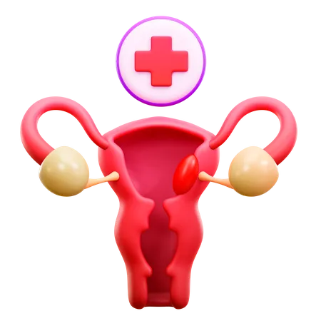 Cáncer de cuello uterino  3D Illustration