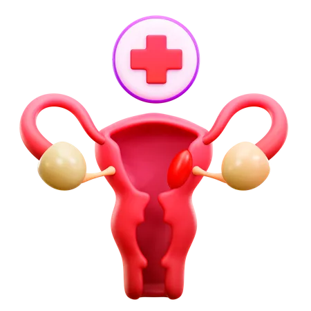 Cervical Cancer  3D Illustration