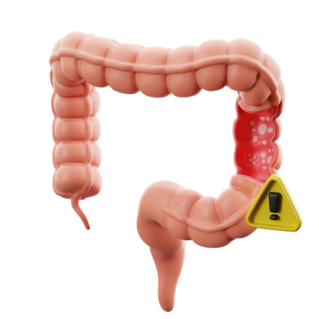 Colitis ulcerosa  3D Icon