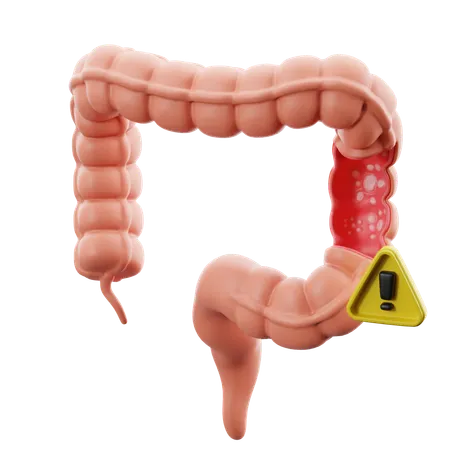 Colitis ulcerosa  3D Icon
