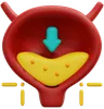 cystitis