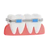 Dental Braces