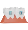 Dental Braces