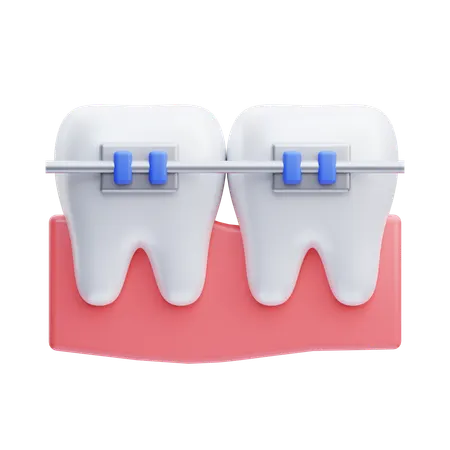 Dental Braces On Teeth  3D Icon