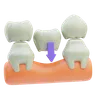 Dental Bridge