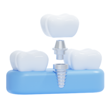 Dental Implant  3D Icon