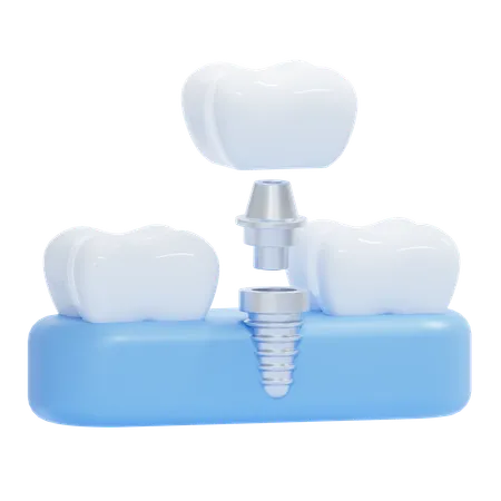 Dental Implant  3D Icon