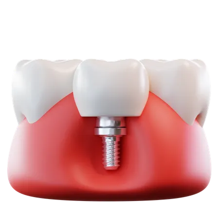 Dental Implant  3D Icon