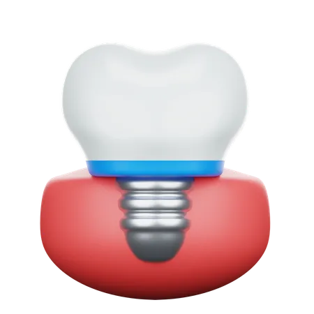 Dental Implant  3D Icon