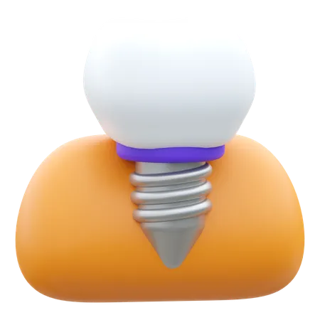 Dental Implant  3D Icon