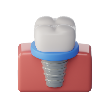 Dental Implant  3D Icon