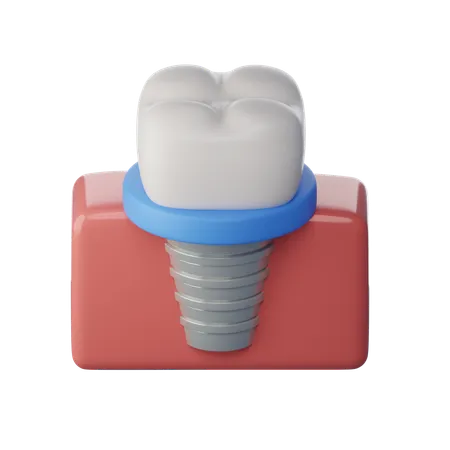 Dental Implant  3D Icon