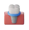 Dental Implant