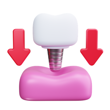 Dental Implant  3D Icon