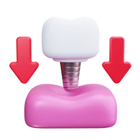 Dental Implant  3D Icon