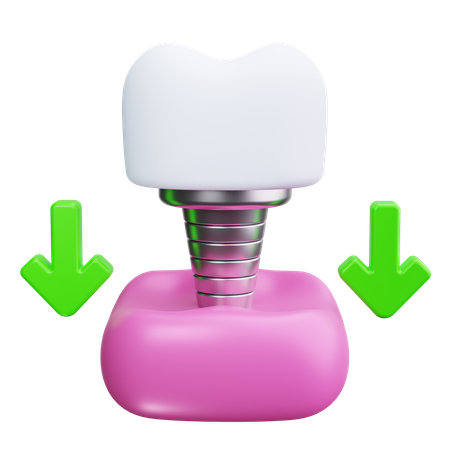 Dental Implant  3D Icon