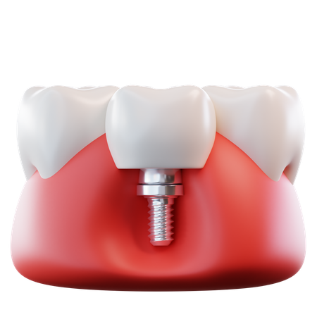 Dental Implant  3D Icon