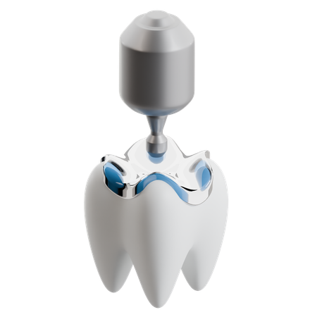 Dental Implant Procedure  3D Icon