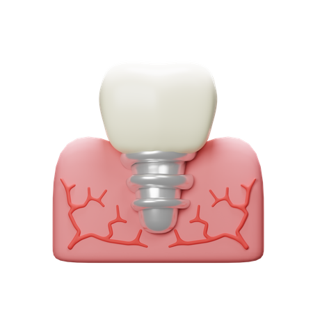 Dente de implante  3D Icon