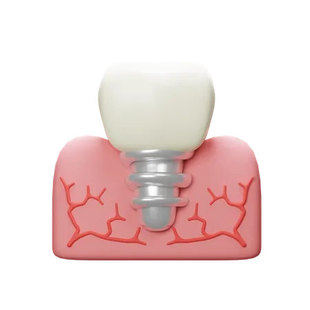 Dente de implante  3D Icon