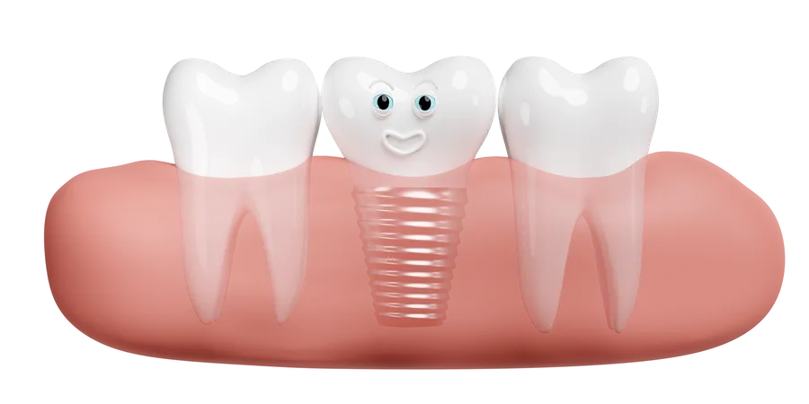 Gengiva com implante dentário  3D Illustration