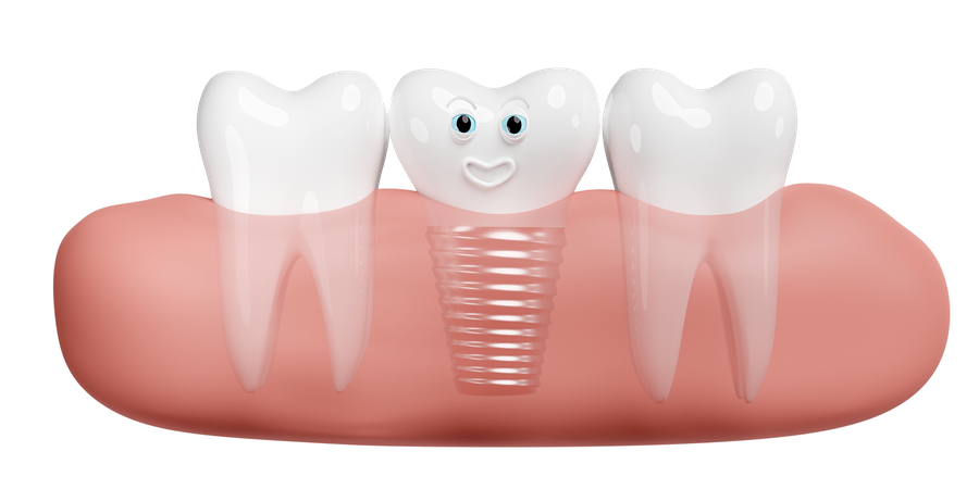 Gum with dental implant  3D Illustration