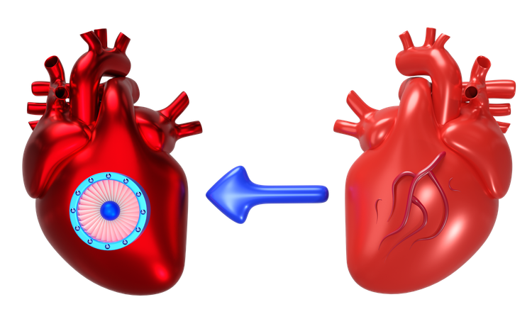 Heart Transplantation  3D Icon