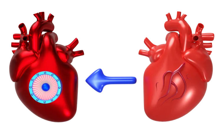 Heart Transplantation  3D Icon