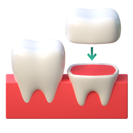 Implant de couronne dentaire  3D Icon