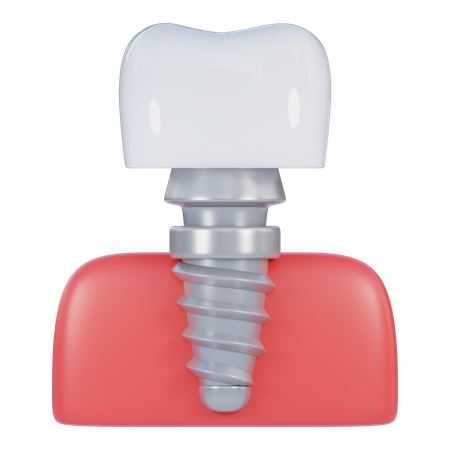 Implant dentaire  3D Icon