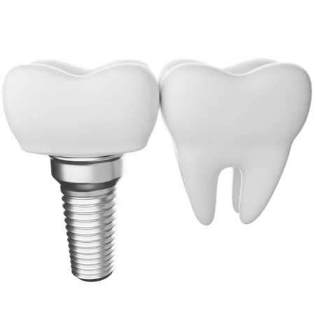Implant dentaire  3D Illustration