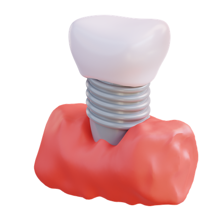 Implant dentaire  3D Icon